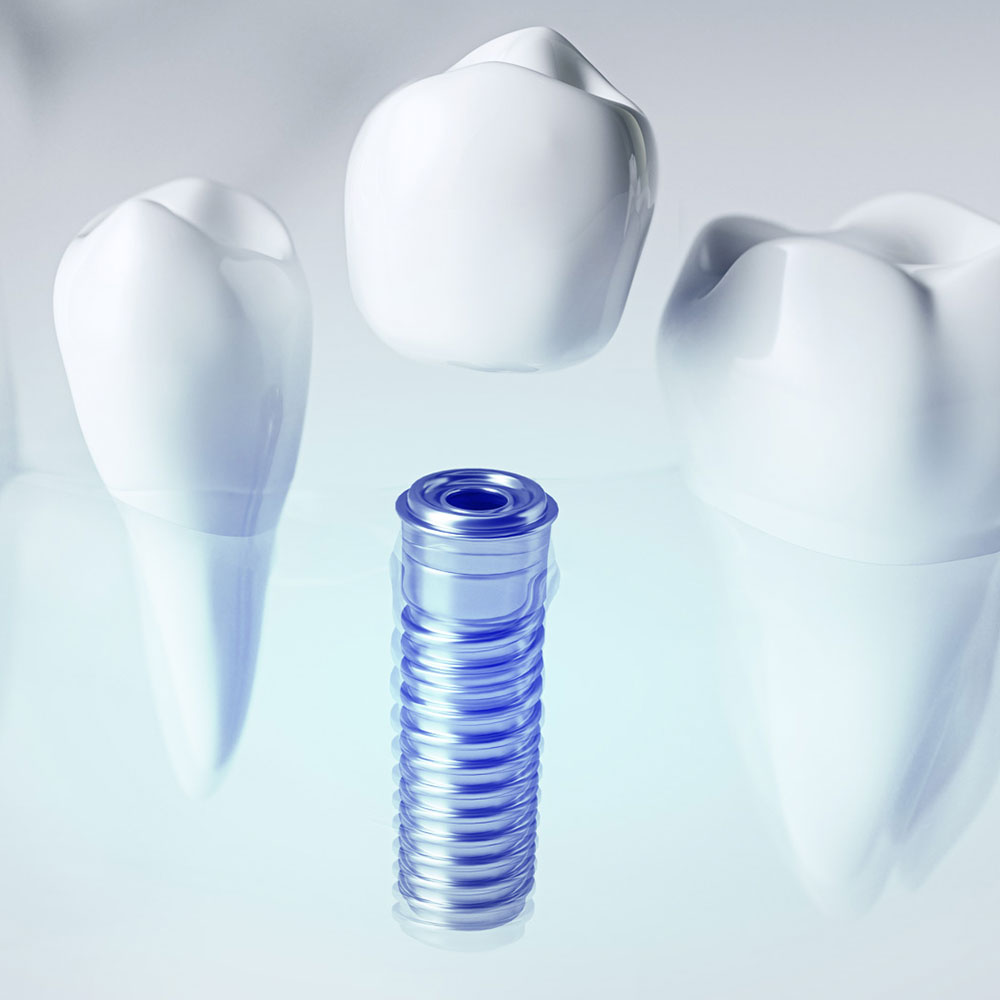 Dentalni implantati